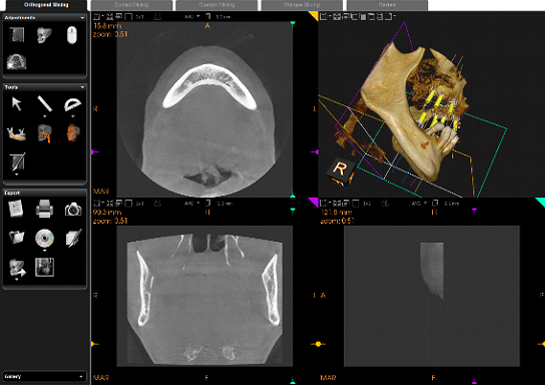 CBCT/OPG