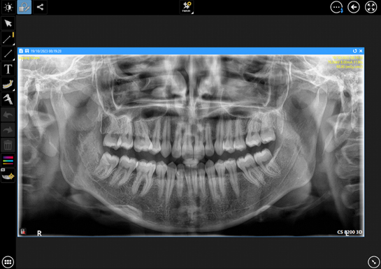 CBCT/OPG