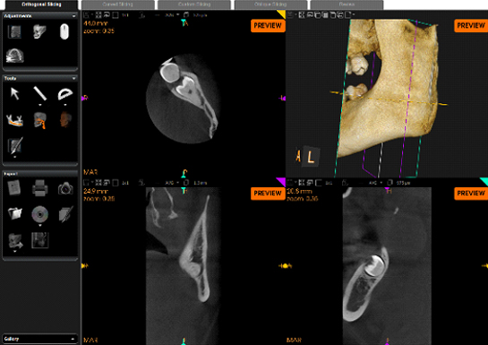 CBCT/OPG