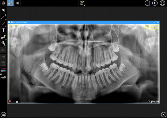 CBCT/OPG